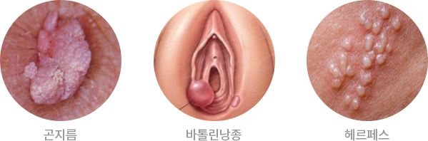 곤지름, 바톨린낭종, 헤르페스
