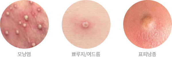 모낭염, 뾰루지, 표피낭종